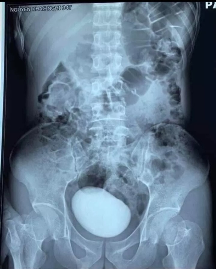 นิ่วยักษ์ หนักเกือบครึ่งกิโล