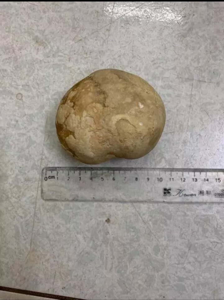 นิ่วยักษ์ หนักเกือบครึ่งกิโล