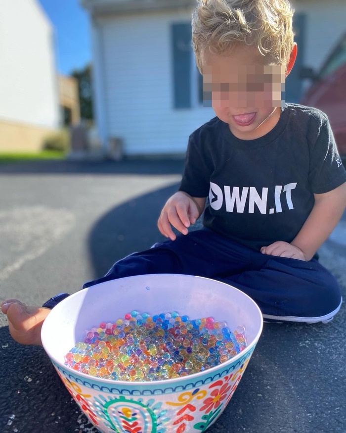 ลิ้นโตแต่กำเนิด