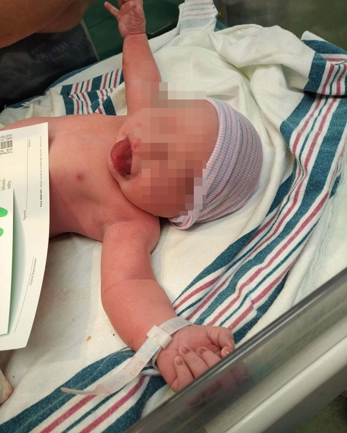 ลิ้นโตแต่กำเนิด