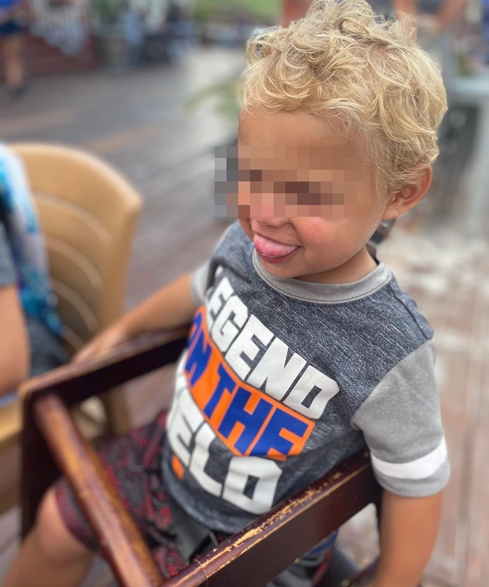 ลิ้นโตแต่กำเนิด