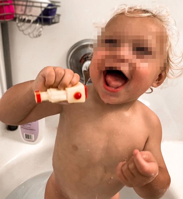 ลิ้นโตแต่กำเนิด