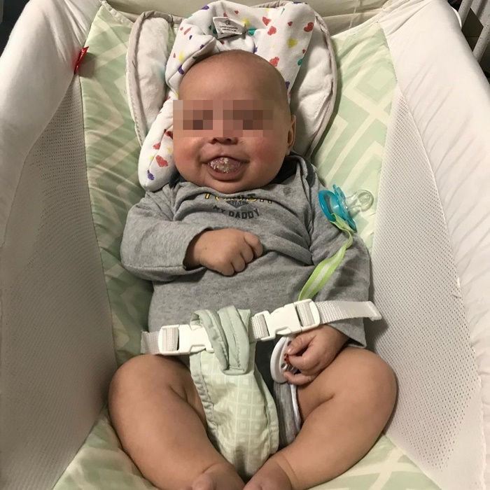 ลิ้นโตแต่กำเนิด