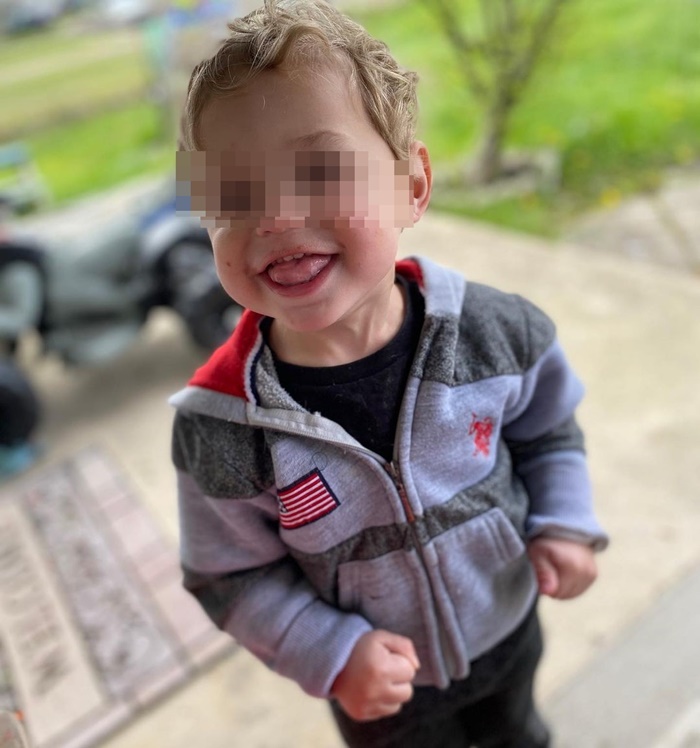 ลิ้นโตแต่กำเนิด