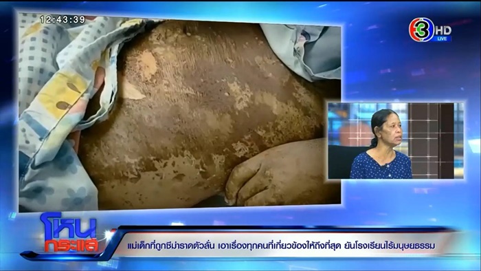  เด็ก 9 ขวบ โดนราดซีม่า