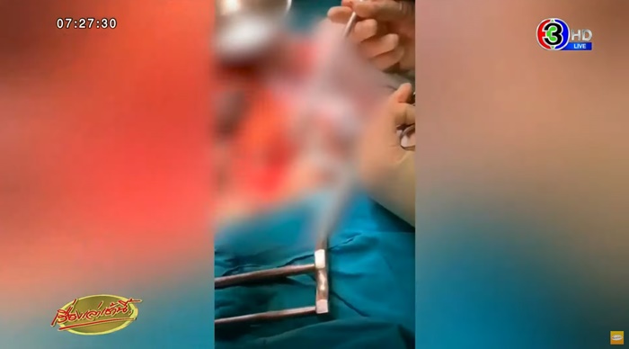 กลืนตะปูลงท้อง