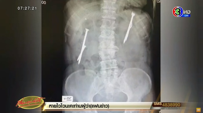 กลืนตะปูลงท้อง