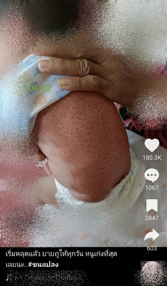 ใช้น้ำหมากถูขนแปรงทารก 