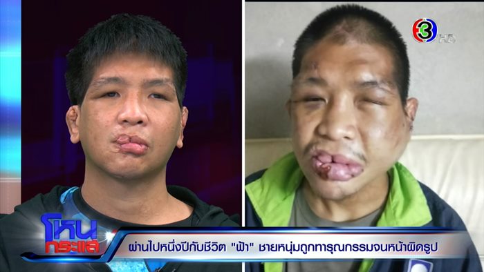 ชีวิตใหม่.. น้องฟ้า ถูกนายจ้างทารุณ 