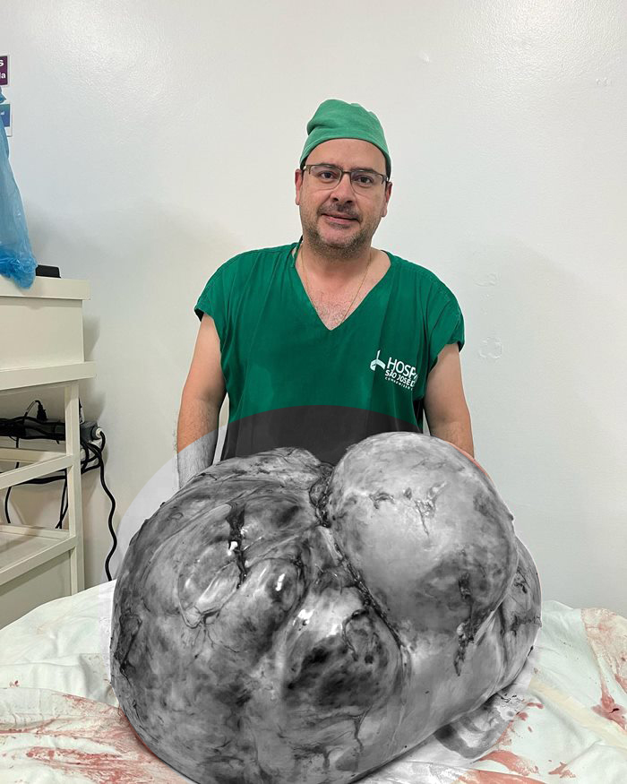 เนื้องอกยักษ์