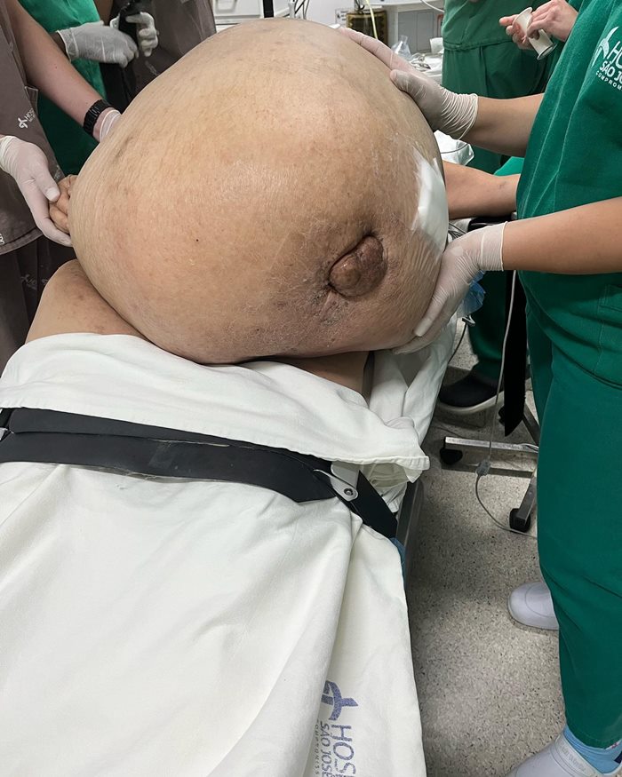 เนื้องอกยักษ์