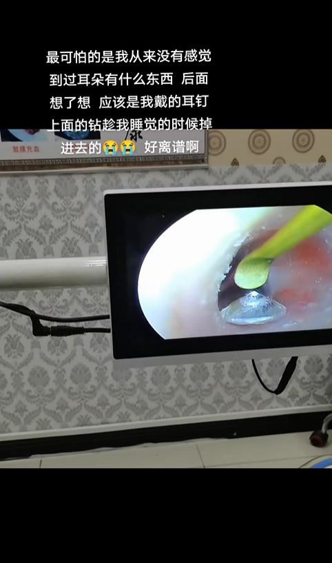 วัตถุแปลกปลอมในหู