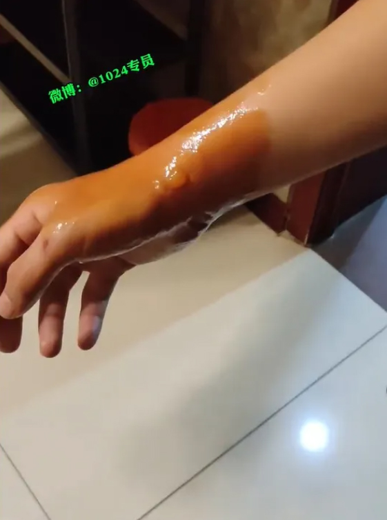 พนง. ทำซุปร้อนหกใส่ลูก