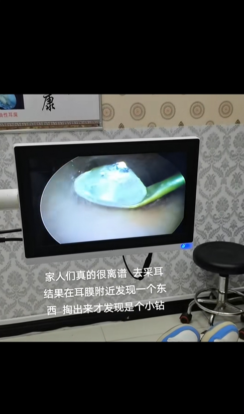 วัตถุแปลกปลอมในหู