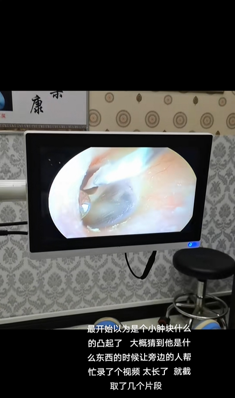 วัตถุแปลกปลอมในหู