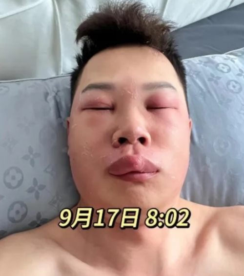  แคะจมูกจนหน้าบวม