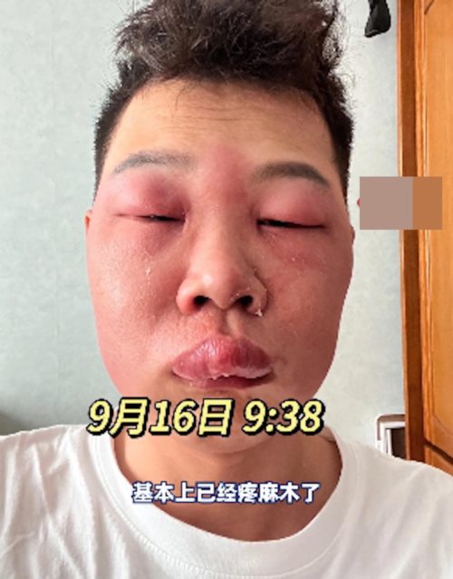  แคะจมูกจนหน้าบวม