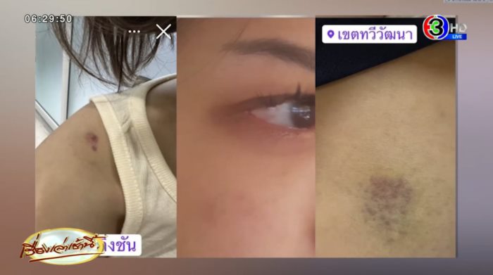  ส.ส. ก้าวไกล ทำร้ายผู้หญิง 