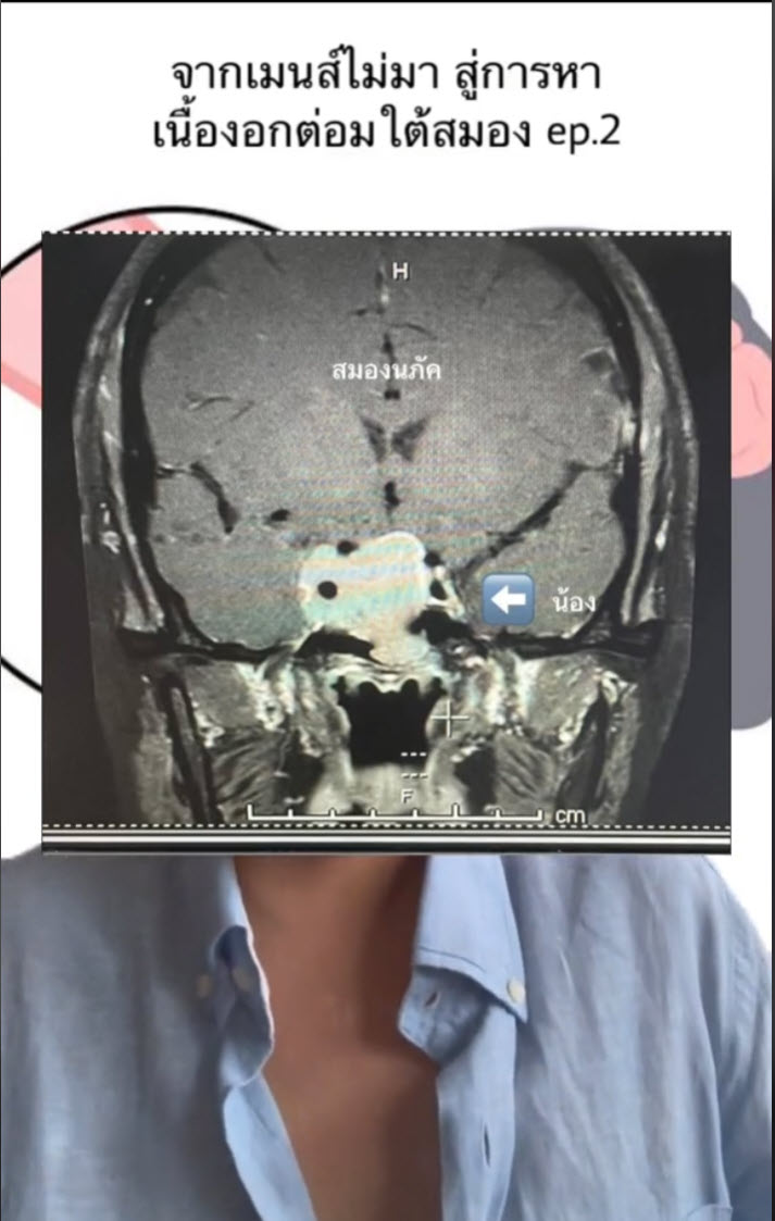 เนื้องอก