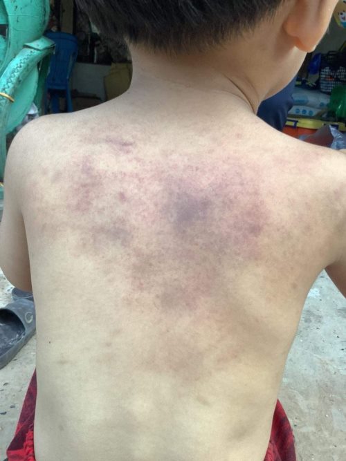 ครูใช้ถาดหลุมฟาดเด็ก