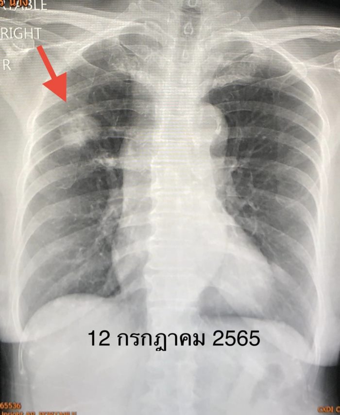 มะเร็งปอด