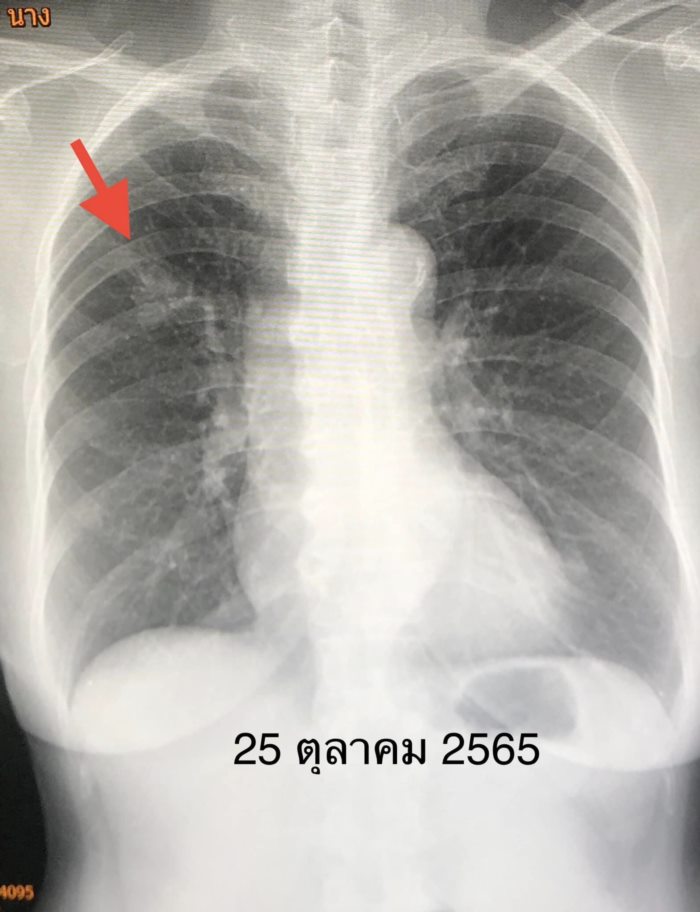 มะเร็งปอด