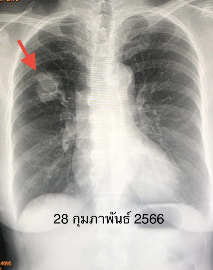 มะเร็งปอด