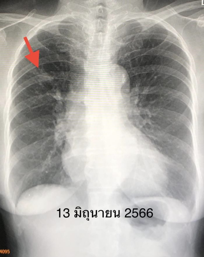 มะเร็งปอด