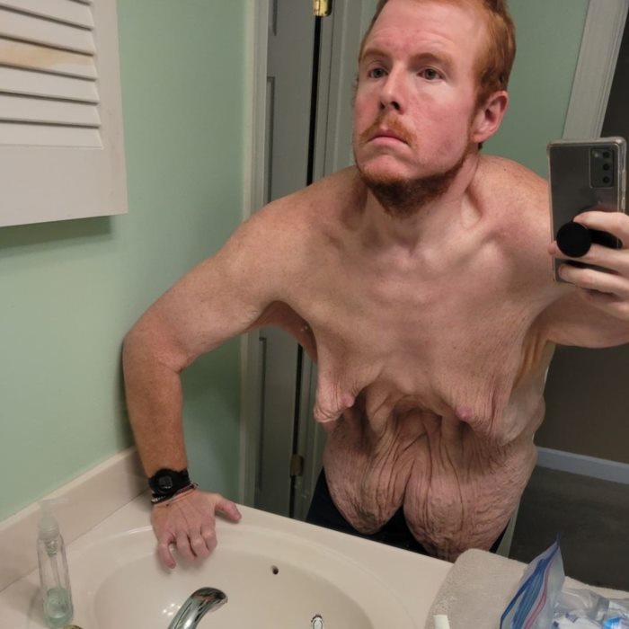 พลิกชีวิต จากอดีตอ้วน 383 กก. 