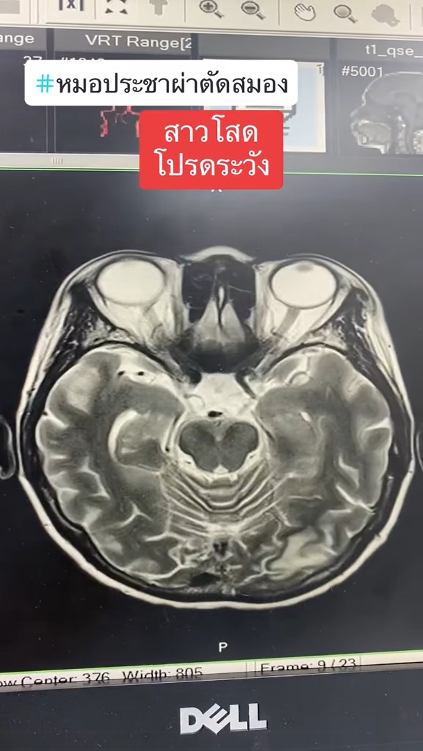  มะเร็งรังไข่