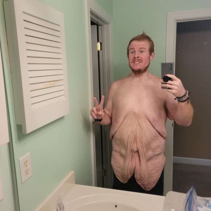 พลิกชีวิต จากอดีตอ้วน 383 กก. 