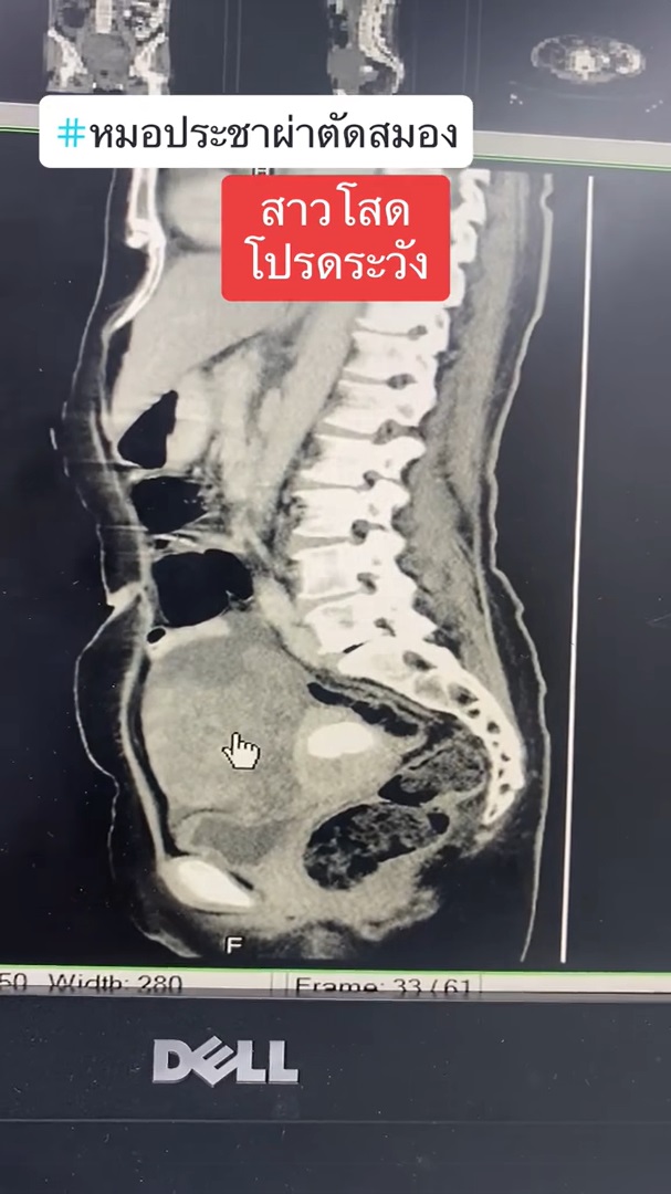  มะเร็งรังไข่