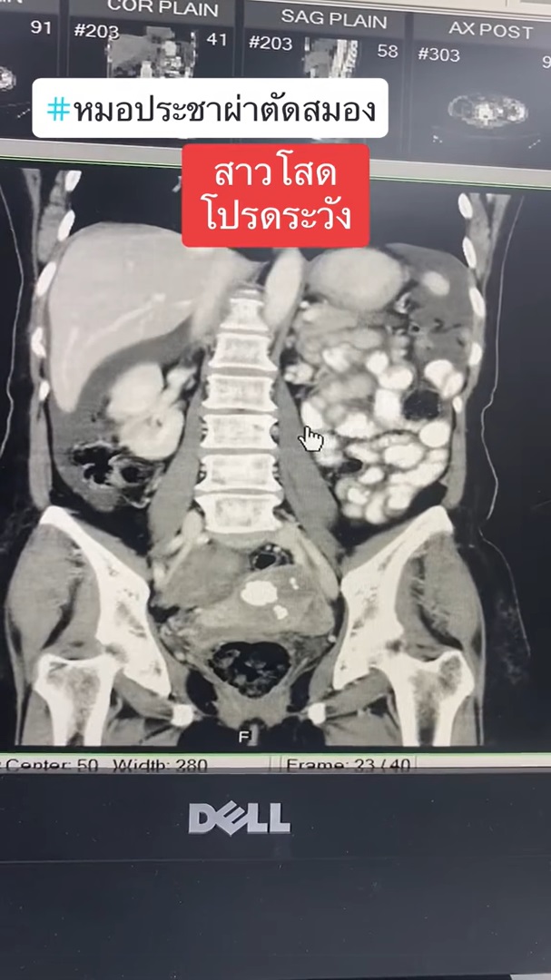  มะเร็งรังไข่