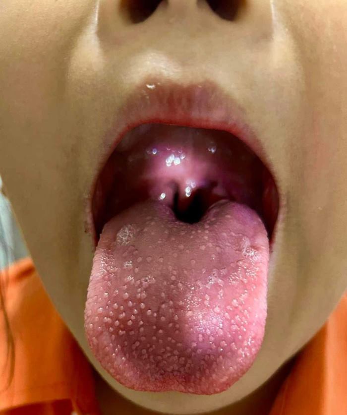   เด็กป่วย ไข้อีดำอีแดง