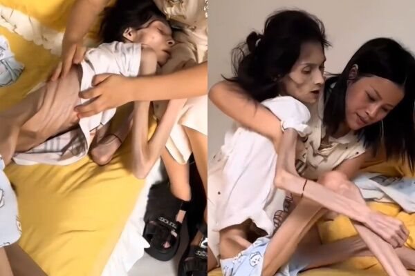 สาวหนักแค่ 17 กก. กระเพาะอาหารฝ่อ 