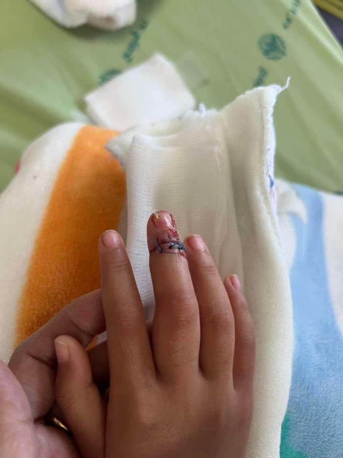 เด็กอนุบาล 3 ถูกแกล้งจนนิ้วขาด 