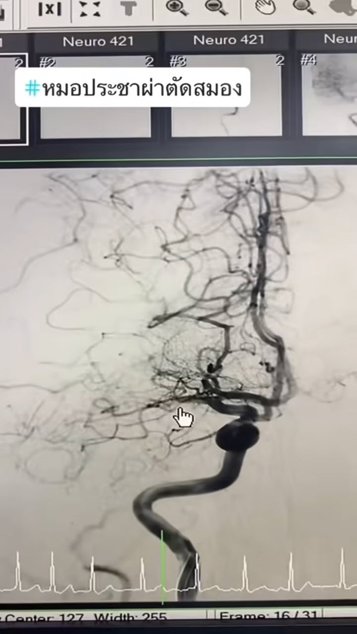 หญิง 50 ดื่มกาแฟแล้วใจสั่น