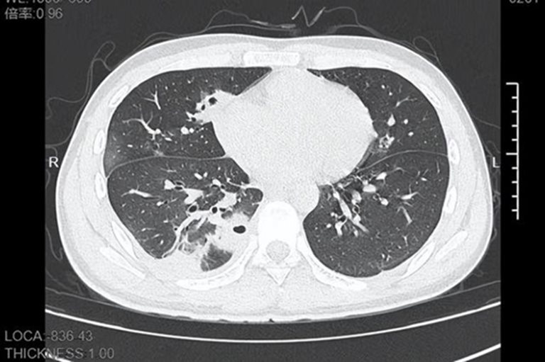 ฝีในปอด