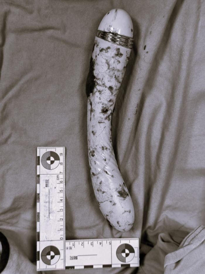 ลำไส้ทะลุ