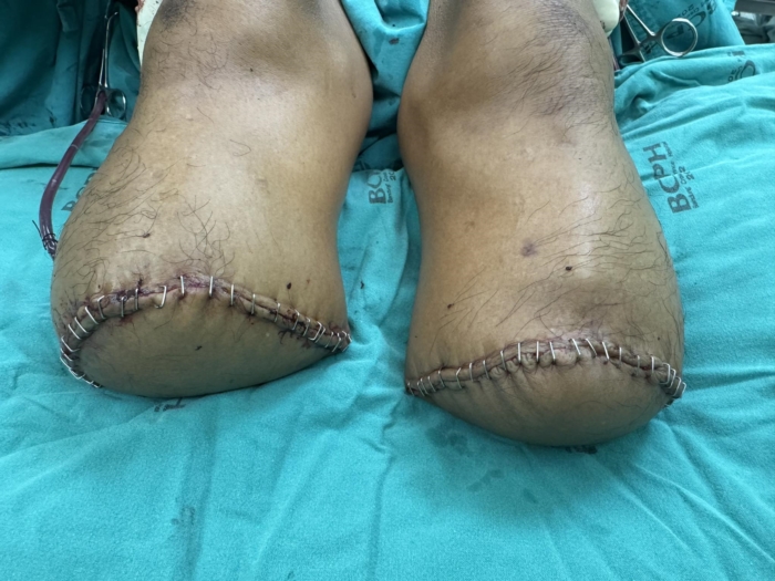  เบาหวาน ตัดขา