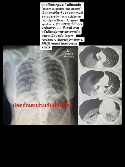  ยุ้ย ดาว TikTok เสียชีวิต