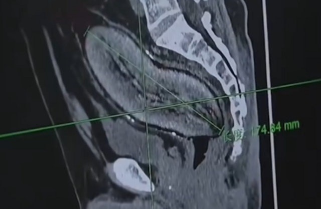มันเทศลูกใหญ่ 17 ซม. ติดลึกในลำไส้ 