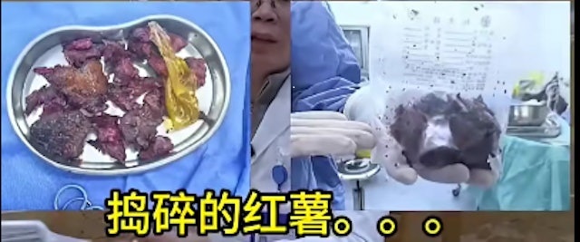 มันเทศลูกใหญ่ 17 ซม. ติดลึกในลำไส้ 