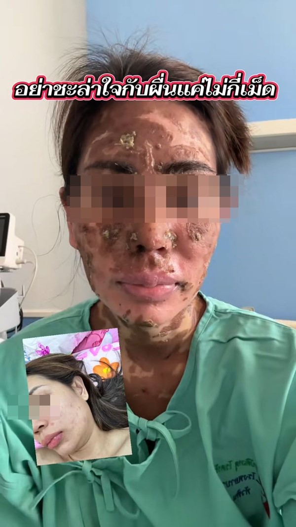  ผื่นขึ้น อย่ามองข้าม 