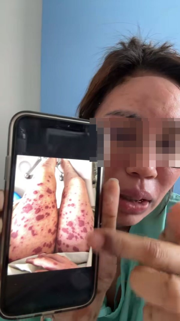  ผื่นขึ้น อย่ามองข้าม 