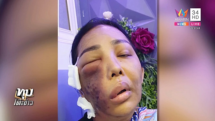 ศัลยกรรมหน้าพัง