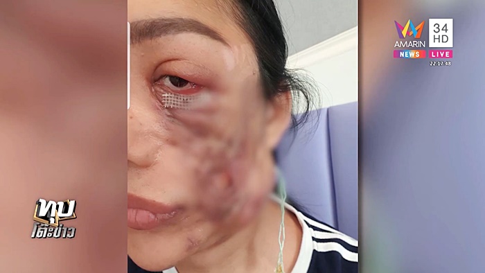 ศัลยกรรมหน้าพัง