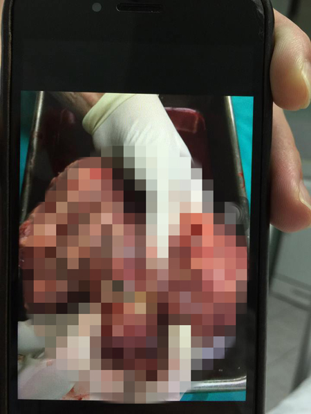 เนื้องอกในรังไข่