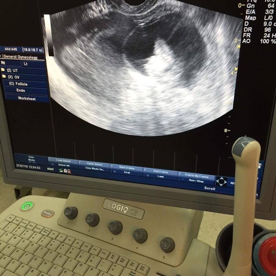 เนื้องอกในรังไข่