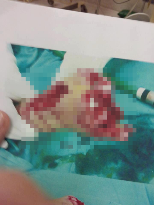 เด็ก 16 ปี ถูกอาชีวะรุม 50 ต่อ 1 แทงทะลุปอด ตัดนิ้วมือด้วน